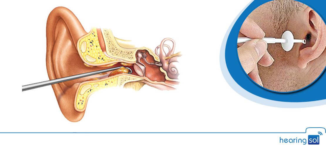 Remove Earwax Naturally