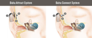 BAHA Bone conduction Implant