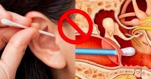 Ear infection due to Q-tips