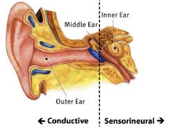 Treatment for conductive hearing loss