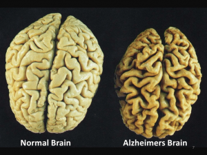 difference in the size of normal and Alzheimer brain