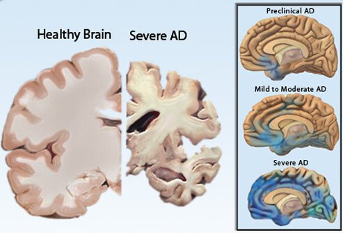 severe dementia causes brain shrinking