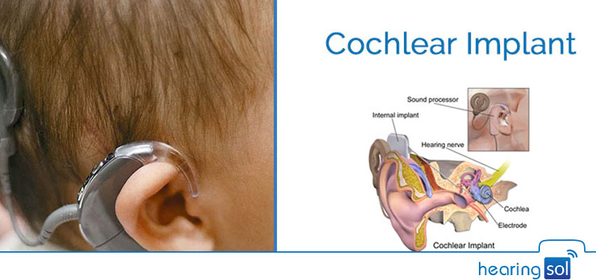 Cochlear Implant