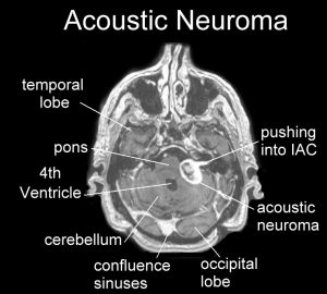 MRI acoustic neuroma