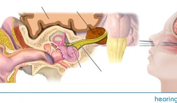 Vestibular Schwannoma