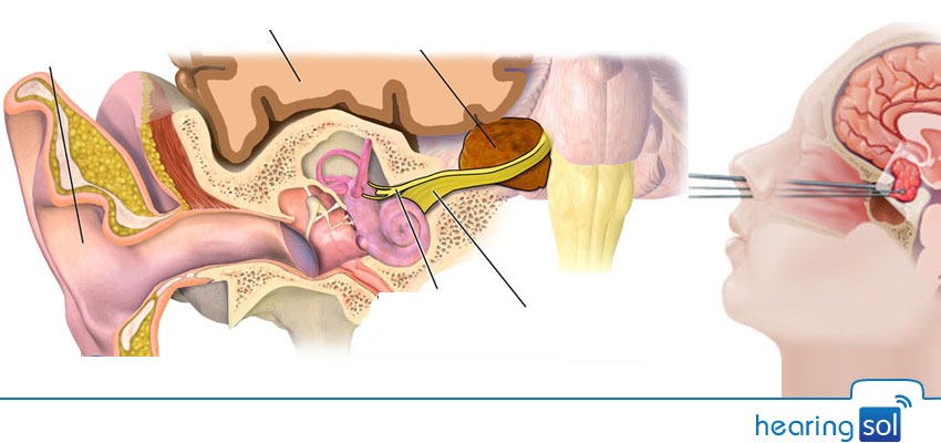 Vestibular Schwannoma