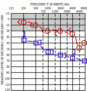 audiometry hearing test