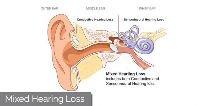 Mixed Hearing Loss Know Cause Symptoms Best Treatment
