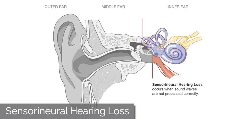 Sensorineural Hearing Loss