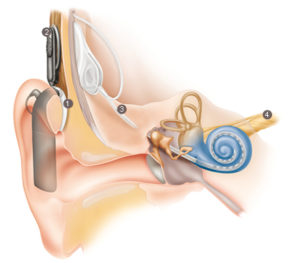 cochlear implant