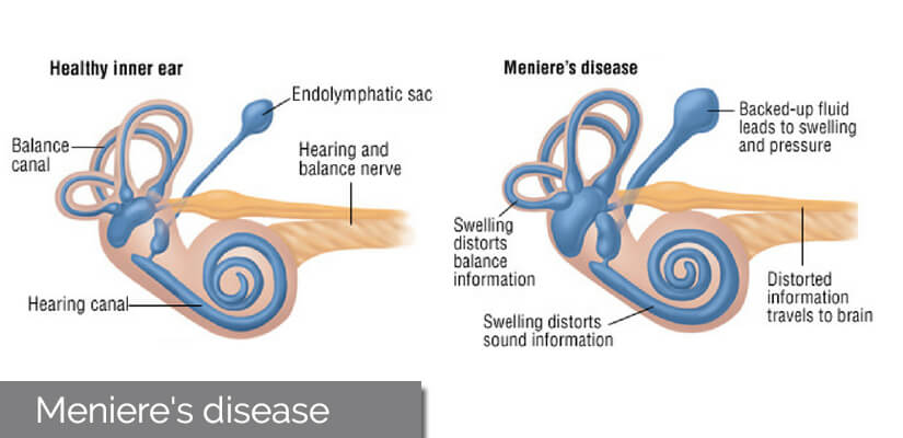 Meniere's disease