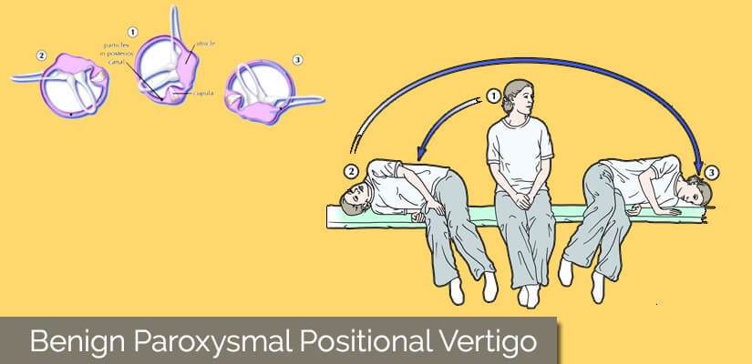 Benign Paroxysmal Positional Vertigo BPPV