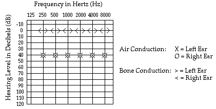 conductive hearing loss audiogram