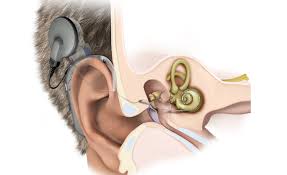 Cochlear Implant