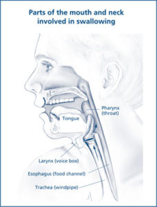 dysphagia occur