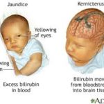 hearing loss due to neonatal jaundice
