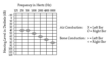 sensorineural hearing loss audiogram