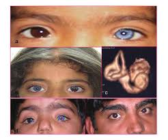 waardenburg syndrome 1