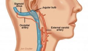 Blood flow in pulsatile tinnitus