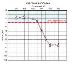 Hearing Losses Named & Classified Based On Audiogram