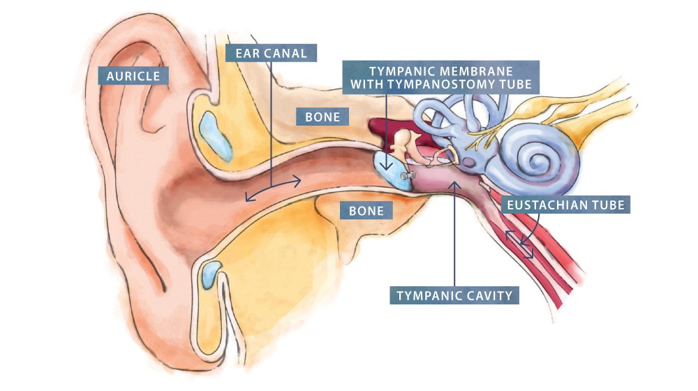 Tympanostomy tubes