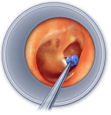  ear tube insertion