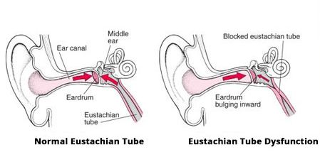 Eustachian Tube Dysfunction