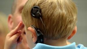 Young children with profound hearing loss benefit from cochlear implants