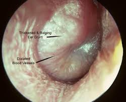  Hearing Loss last after Ear Infection