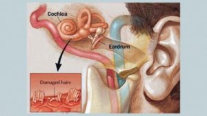 Loss of sensory hair cells