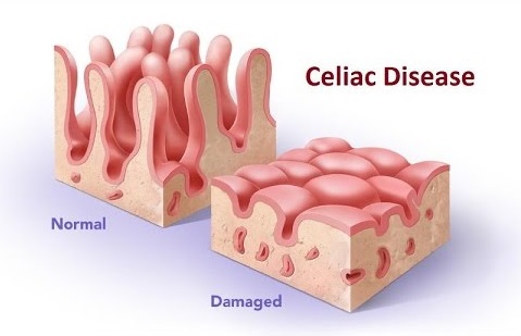 Celiac diseases damaging the intestine causes autism in child