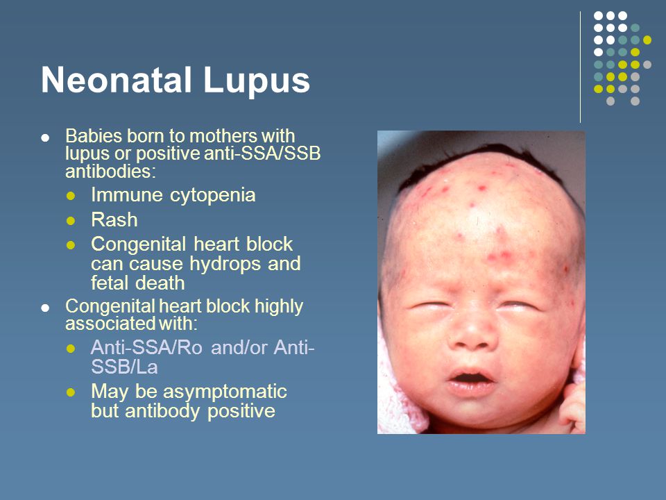 Neonatal Lupus