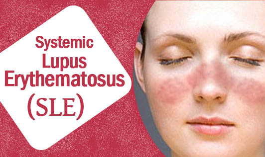 SLE Lupus