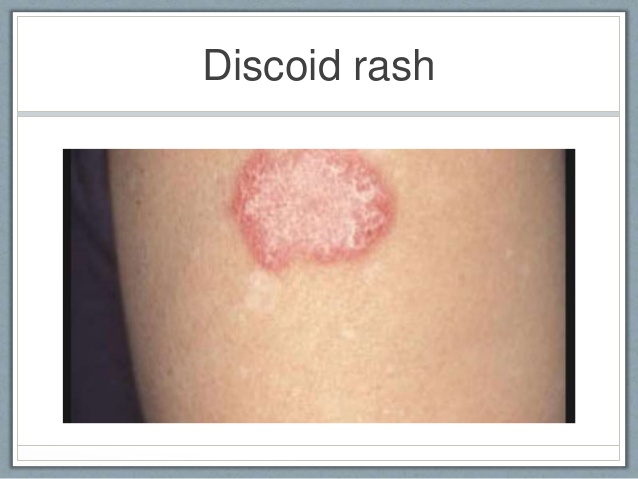 Discoid Rash