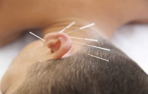 Acupuncture therapy to improve hearing