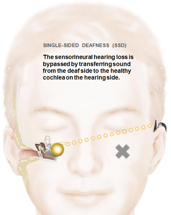 BAHA single sided deafness