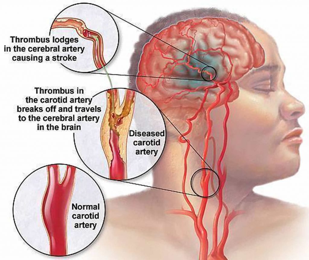 Carotid Artery Disease