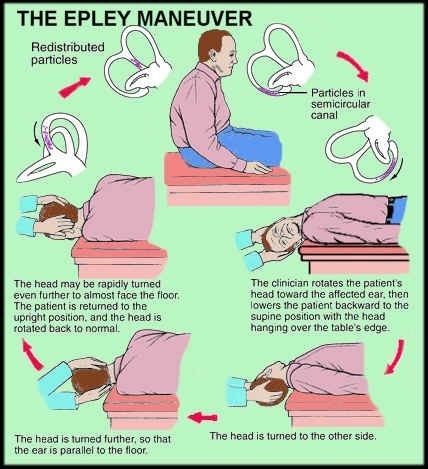 Epley Maneuver Exercise