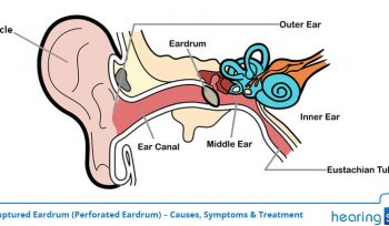 Ruptured Eardrum (Perforated Eardrum) - Causes, Symptoms & Treatment