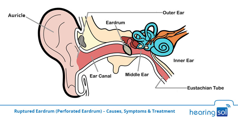 Ruptured Eardrum (Perforated Eardrum) - Causes, Symptoms & Treatment