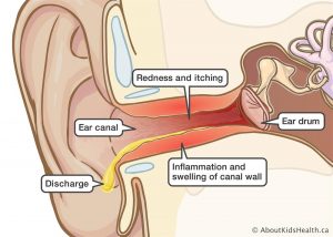 swimmers ear