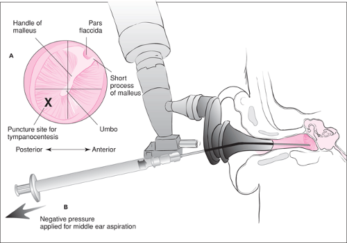 Tympanocentesis