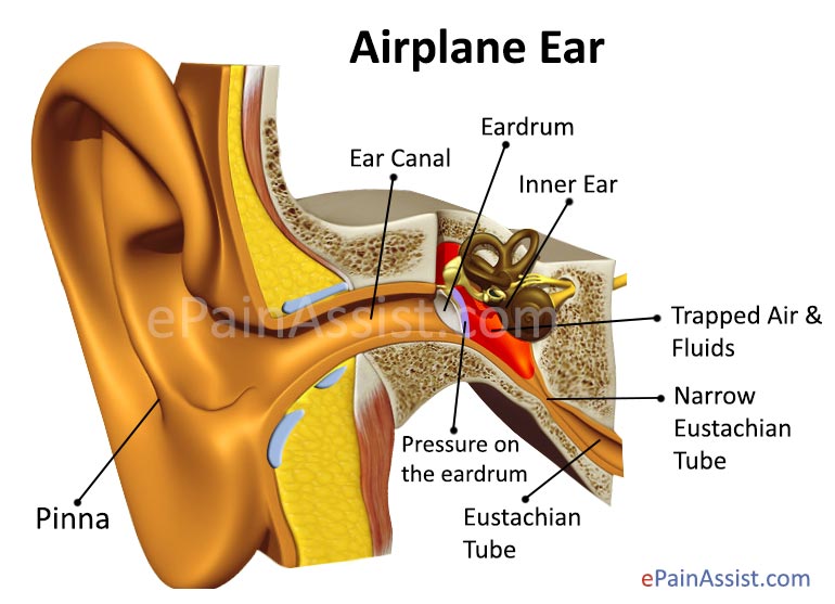 What Causes Ear Pain in Flight or Airplane Ear