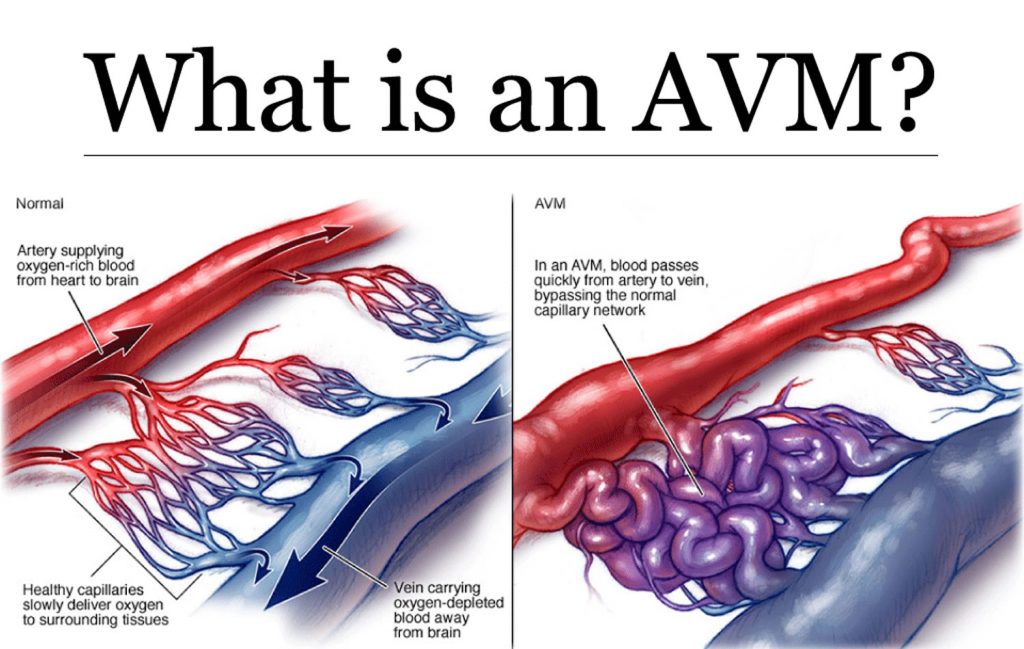arteriovenous malformation