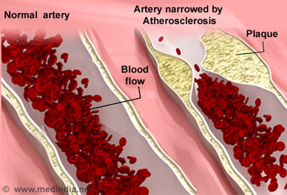 Atherosclerosis