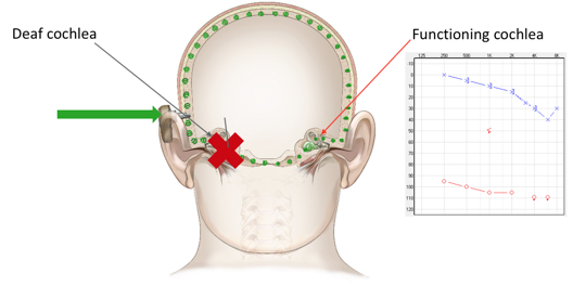 audiogram of unilateral hearing loss