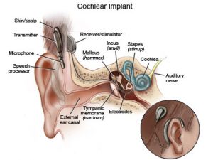 cochlear implants