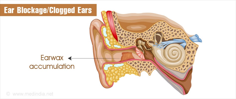 Clogged Ears Stopped Up Ear 7 Instant Ways To Unclog Fix