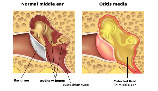 Middle Ear Infections