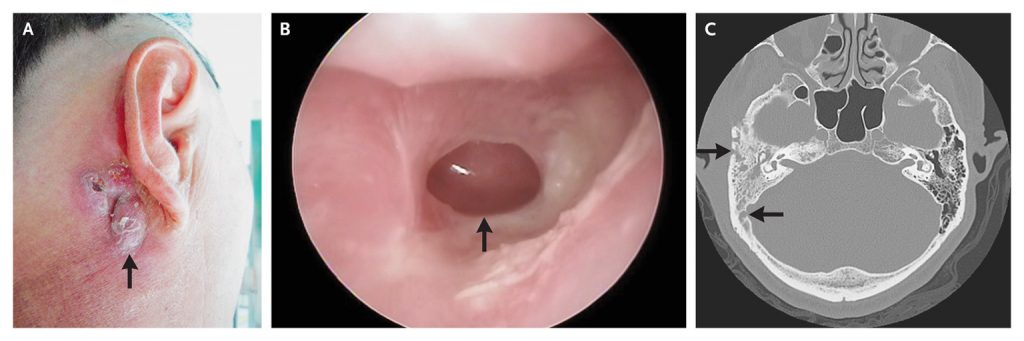 mastoiditis